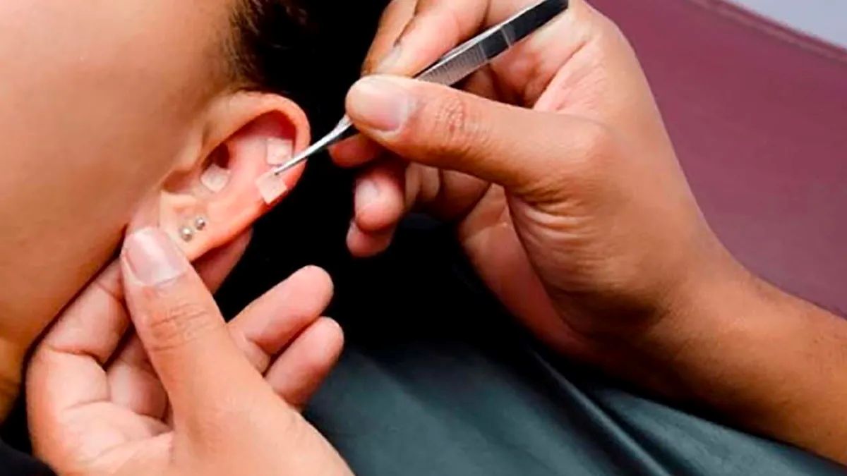 Auriculoterapia