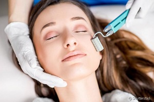 microagulhamento_facial